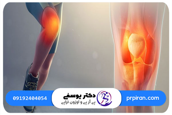 درد زانو با تزریق prp ایران