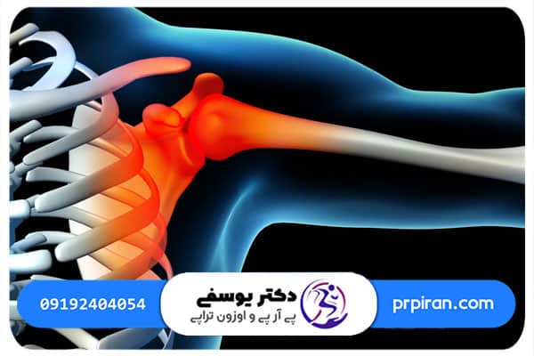 شایع&zwnj; ترین علت درد شانه چیست؟