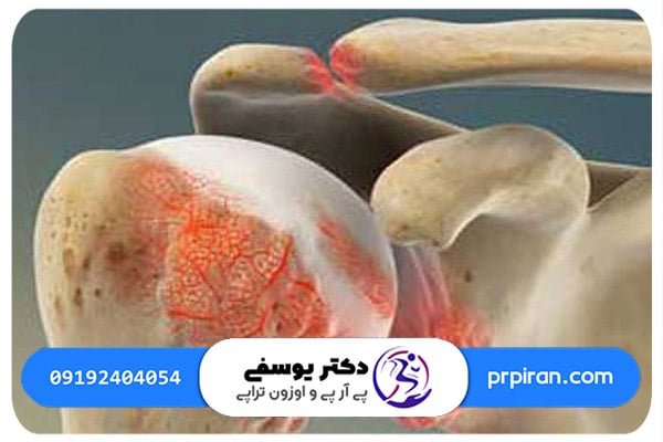  آرتروز شانه چطور ایجاد می&zwnj; شود؟