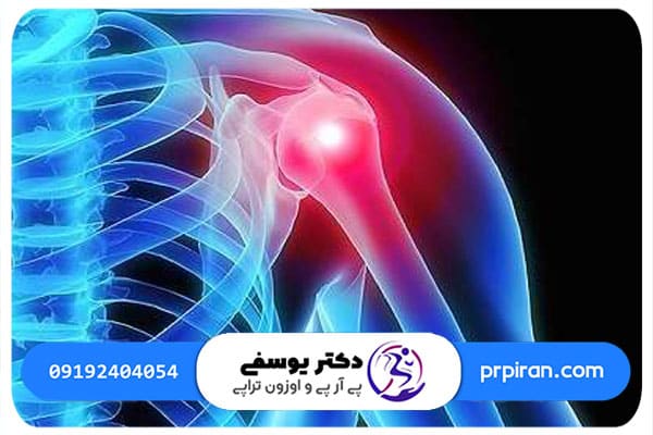 آشنایی با راه های درمان شانه یخ زده