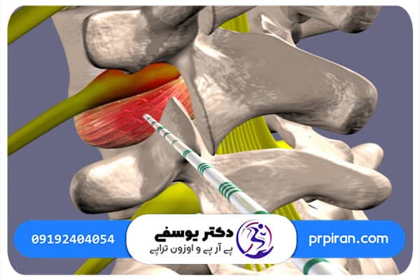 تعرفه و هزینه اوزون تراپی شانه