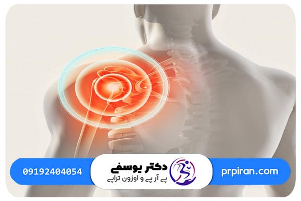 راه&zwnj; های درمان آرتروز شانه