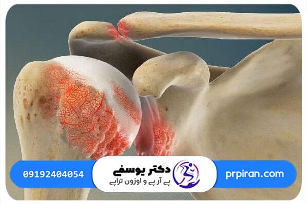 راه&zwnj; های درمان علائم ساییدگی شانه