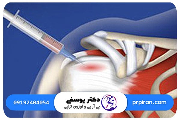 اوزون تراپی و روش&zwnj; های درمان تاندونیت شانه چیست؟