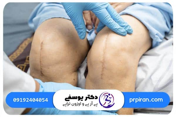 شرایط انجام ورزش بعد از پی آر پی زانو