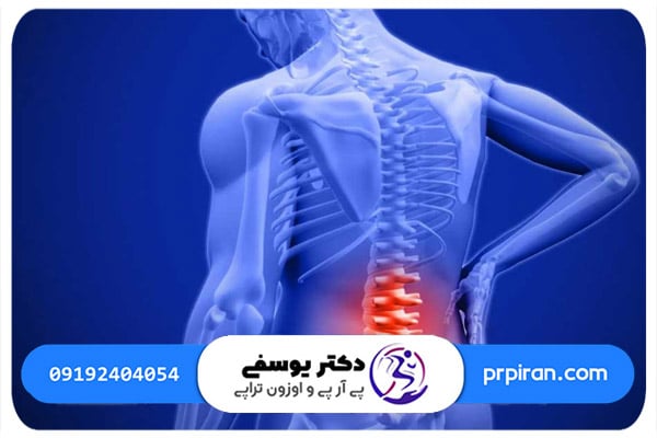  مراحل اوزون تراپی دیسک کمر در کلینیک دکتر یوسفی