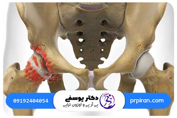 شایعترین علائم ساییدگی لگن