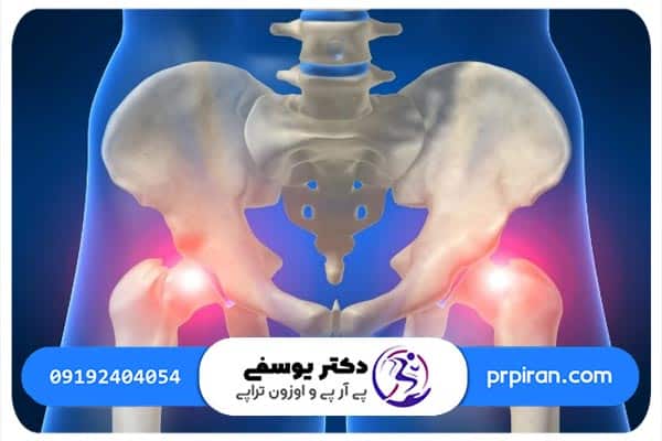 پارگی لابروم لگن